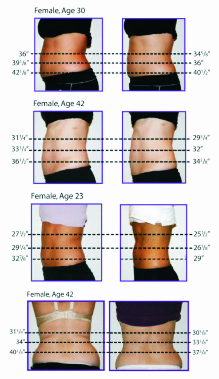 Lipolaser